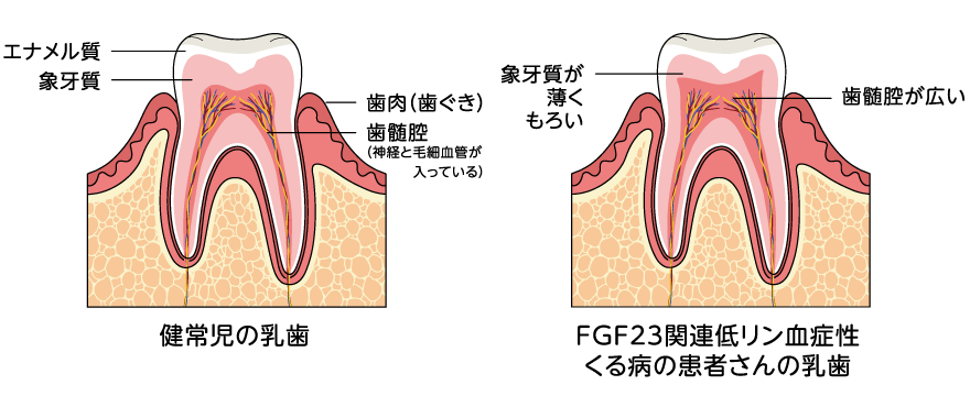 図1　健常児の乳歯とくる病の患者さんの乳歯の断面図